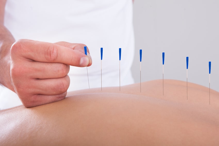 Akupunktur Anwendung - Physiotherapie